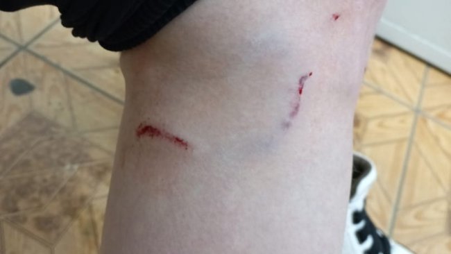 В Бузулуке собаки покусали девушку