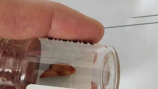 Необычный случай в Орске: у пациента нашли зуб в носу