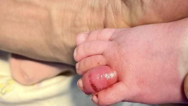 Опасный волос на пальце младенца 